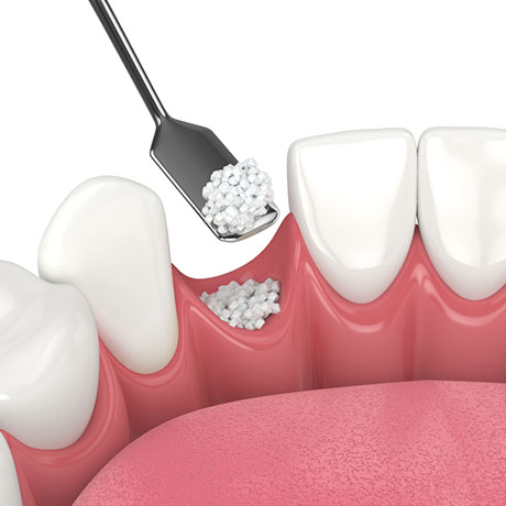 Sinus Lift & Bone Grafting