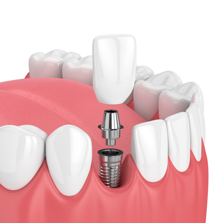 Single and Multiple Implants